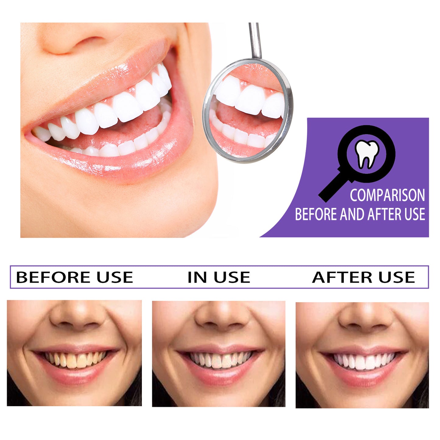 Dentiluz, Blanqueamiento Dental