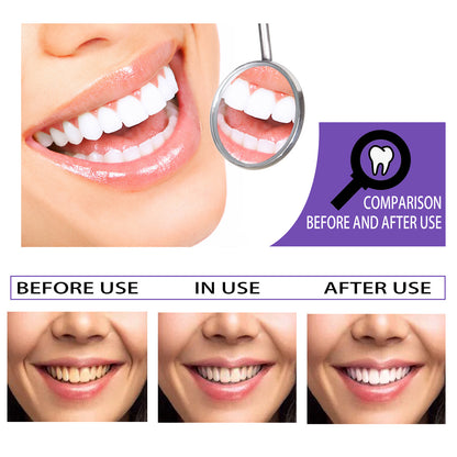 Dentiluz, Blanqueamiento Dental