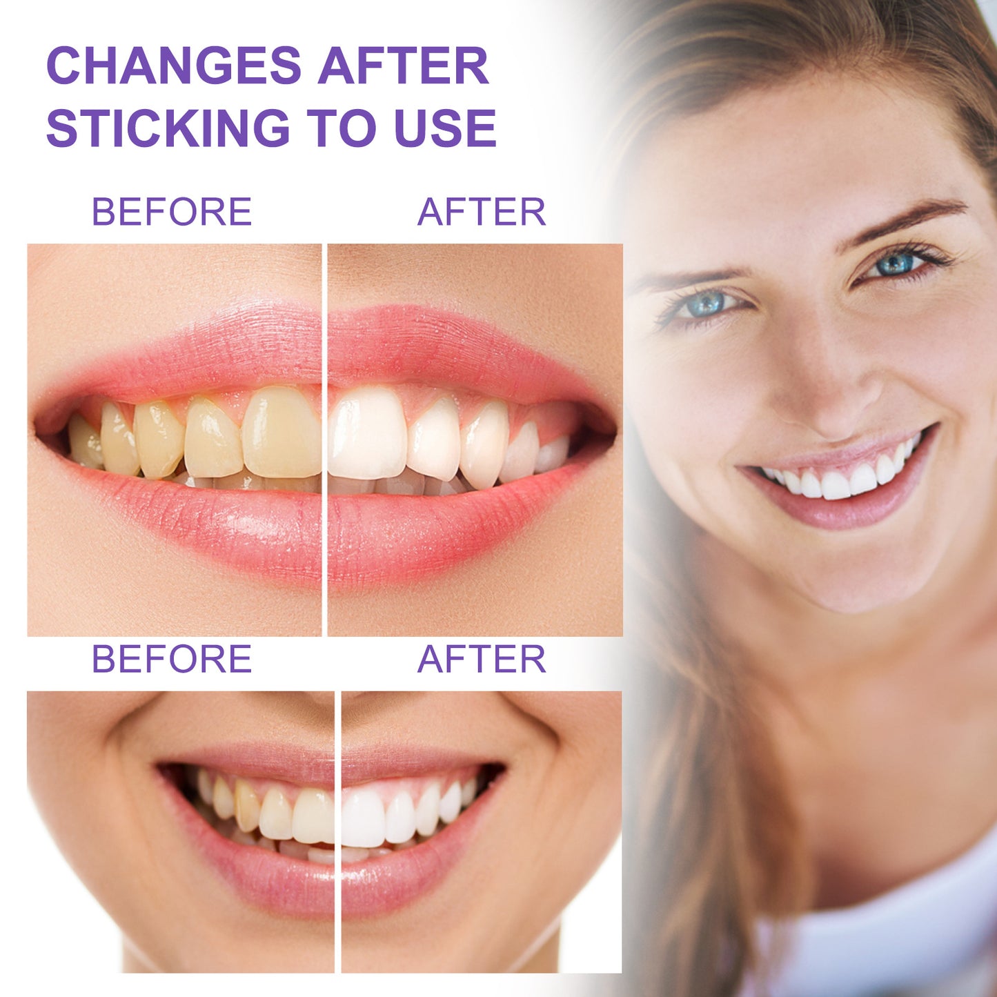 Dentiluz, Blanqueamiento Dental